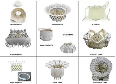 Current Devices in Mitral Valve Replacement and Their Potential Complications